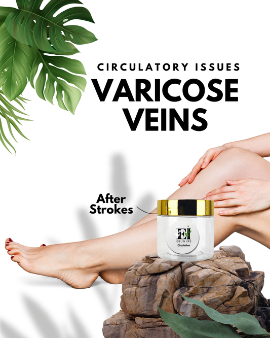 Varicose Veins Remedy